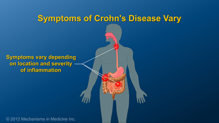 Symptoms of Crohn’s