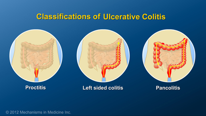 Classifications of Ulcerative Colitis