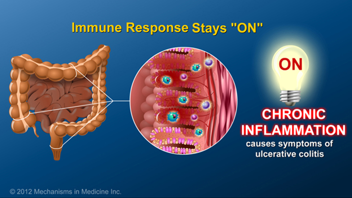 Immune Response in Ulcerative Colitis