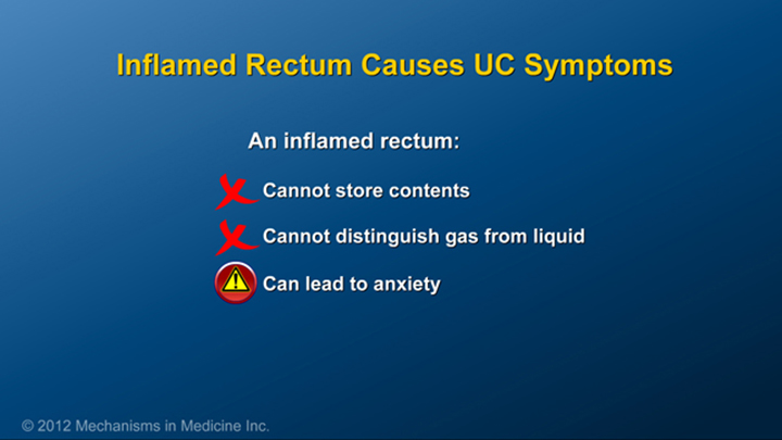 Inflamed Rectum and Ulcerative Colitis