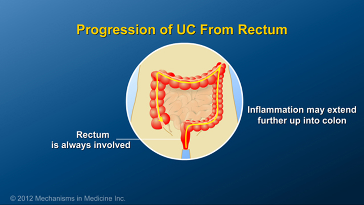Rectum and Ulcerative Colitis