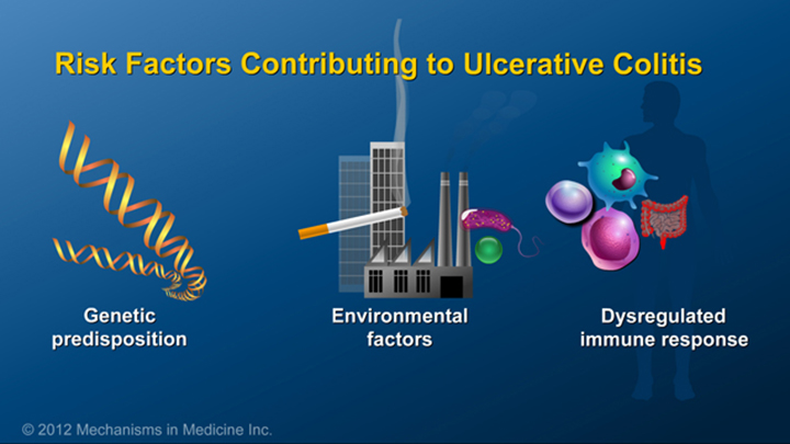 Risk Factors of Ulcerative Colitis