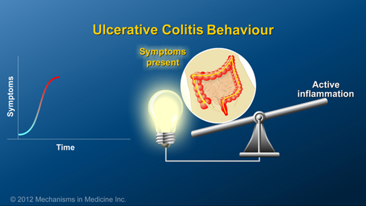 Ulcerative Colitis Behaviour