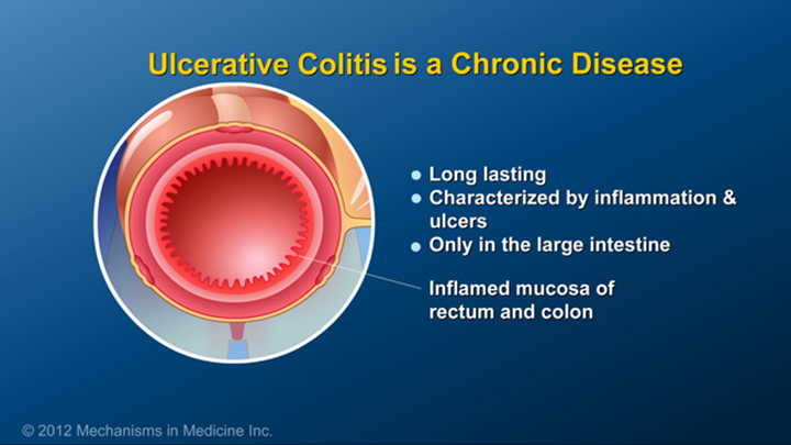 Ulcerative Colitis is a Chronic Condition
